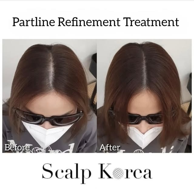 🇺🇸 At Scalp Korea, our mission is to enhance the lives of our clients. From the first consultation
