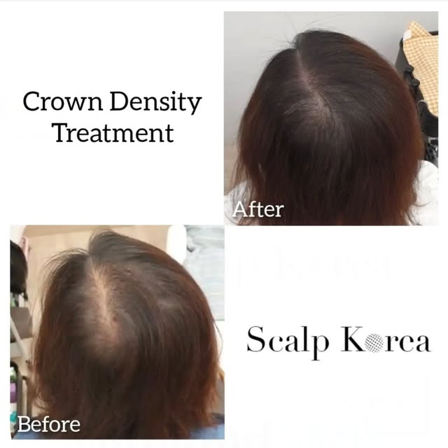 🇺🇸 At Scalp Korea, our mission is to enhance the lives of our clients. From the first consultation