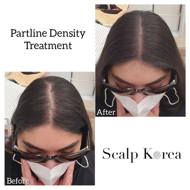 🇺🇸 At Scalp Korea, our mission is to enhance the lives of our clients. From the first consultation