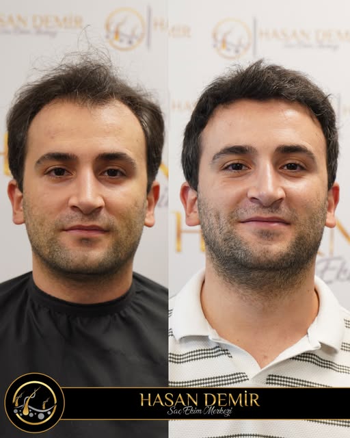 Her saç teli, yeni bir özgüven hikâyesi… Ön hat çalıştığımız Rizgar Gün’ün dönüşümünde yer almaktan 