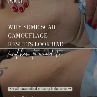 Scar camouflage is a specialized form of paramedical tattooing, and results depend heavily on techni