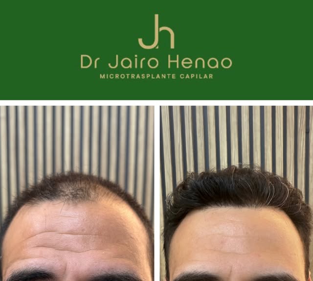 8 meses postrasplante capilar ✨

La evolución ya empieza a mostrar el resultado que buscamos: una lí