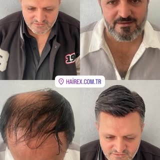 @hairex.samsun @hairexbodrum @hairex_diyarbakir @hairexankara @hairex.samsun @hairexizmir @hairex.ba