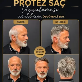 Protez Saç Uygulaması, Doğal Görünüm..

Detaylı bilgi için 0(533) 738 28 76

@hairex.samsun @hairexa