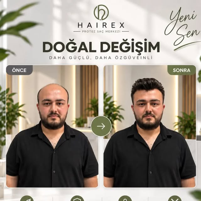 Doğru saç tasarımıyla yüz hatlarına uyum sağlayan, doğal ve özgüvenli bir görünüm.

Her danışanımıza