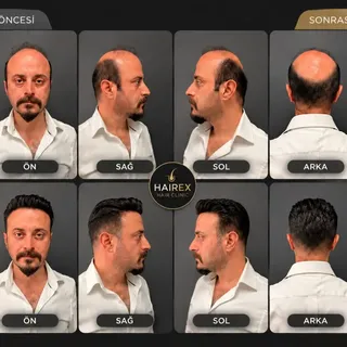 Doğru saç tasarımıyla yüz hatlarına uyum sağlayan, doğal ve özgüvenli bir görünüm.

Her danışanımıza