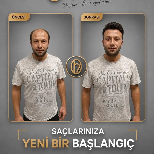 Doğru saç tasarımıyla yüz hatlarına uyum sağlayan, doğal ve özgüvenli bir görünüm.

Her danışanımıza