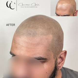 The most challenging case of my career. Photo is fully healed. Scarring alopecia. As the scalp was e