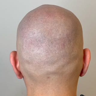 1 year healed crown before touch up. Redness from shaving irritation. Swipe for the before. Natural 