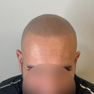 1+ year healed.