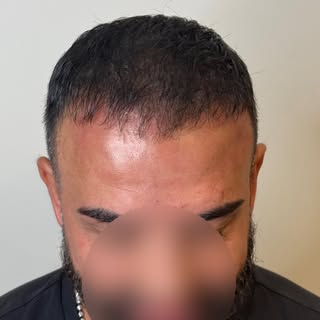 1 year healed density on a low density transplant. You have to be extremely careful to not oversatur