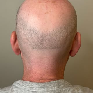 Fully healed FUT scar. With scars I try to get them as close to camouflaged as possible. You’ll neve