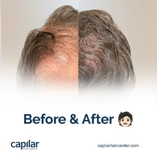 Great changes begin with small steps. ✨

This result reflects how the FUE technique progressively im