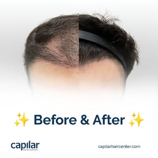It's not just hair, it's recovering your confidence.

Book your appointment now:
📞 USA: (619) 213-0