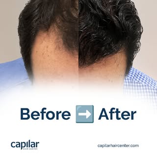 📈 Discover how the FUE technique improves hair quality in a comprehensive and personalized way.

Ma