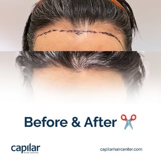 Density, quality, and real appearance. 🔍

✨ This change is the result of the FUE (Follicular Unit E