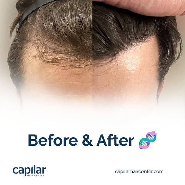 🙌 See the progressive advances in density and quality thanks to our personalized treatment with the