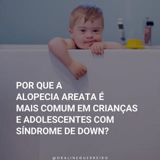 A alopecia areata pode acontecer em qualquer pessoa, mas alguns grupos apresentam uma predisposição 