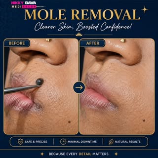 More removal