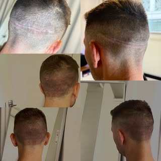 Hair Transplant Scar Camouflage ✨

A visible FUT scar doesn’t have to define your look.

This transf
