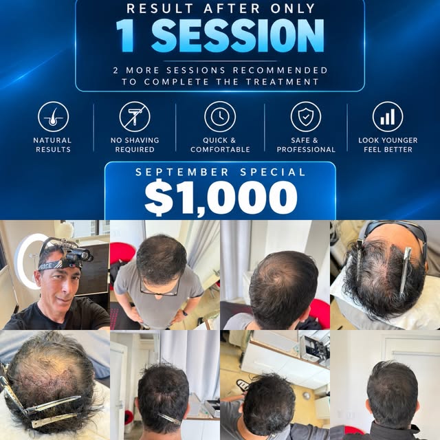 HAIR DENSITY — WITHOUT SHAVING 🔥

This is a REAL CLIENT and the result after ONLY 1 SMP SESSION.

N