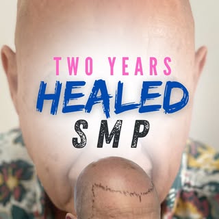 Two years healed work. Come get yours. 

#smp #scalpmicropigmentation #hairlosssolution #santamonica