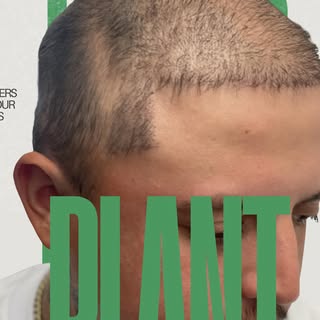 I see this all the time: a young guy comes to me after spending thousands on a hair transplant, only