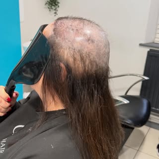 This lovely client came to me after struggling with hair loss caused by trichotillomania (hair-pulli