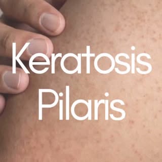Strawberry Skin? Here’s What It Really Means 🍓✨
.
.
.
Tired of those tiny bumps on your arms or thi