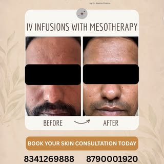 Topicals work on the surface.
IV Infusions + Mesotherapy work deeper at the cellular level.

This tr
