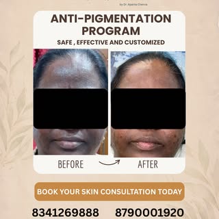 When pigmentation affects confidence, it’s not just a cosmetic issue.

This before & after shows imp