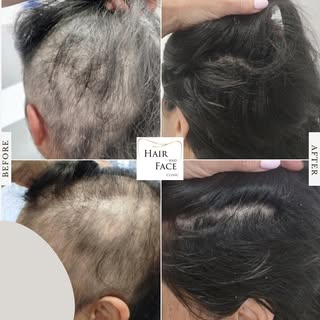 𝐏𝐄𝐋𝐀𝐃𝐄 

Évolution post traitement d’une pelade chronique à 6 mois

Pour plus d’informations o