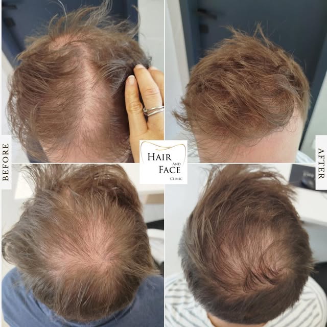 𝐇𝐀𝐈𝐑

Magnifique résultat après seulement 1 séance de PRP cheveux !

Pour plus d’informations ou