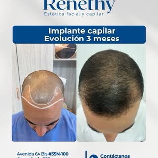 💎La evolución de un implante capilar es un proceso que vale la pena.

A los 3 meses comienza una de