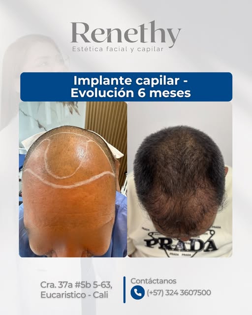 ¡6 meses de evolución que hablan por sí solos! 💙

Cada proceso de implante capilar requiere tiempo,