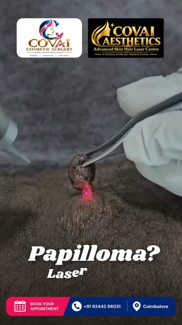 Laser Treatment for Papilloma ✨

Safe. Precise. Minimally Invasive.
Laser treatment can help remove 