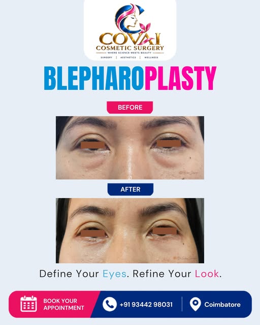 Blepharoplasty – Before & After ✨

Define Your Eyes. Refine Your Look.

Blepharoplasty, or eyelid su