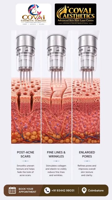 Microneedling is a professional skin-rejuvenation procedure that uses controlled micro-injuries to s
