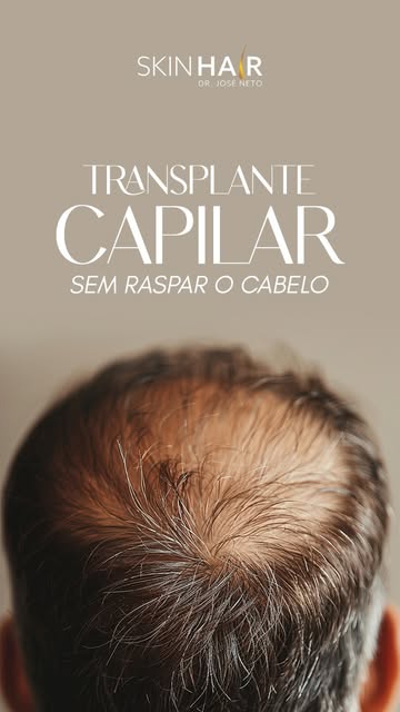 Transplante capilar sem raspagem: conheça a técnica Long Hair! ✨

🧔🏻 Para quem deseja realizar um 