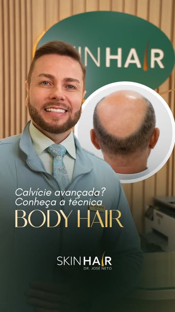 Nem sempre a falta de uma boa área doadora no couro cabeludo significa que o transplante capilar não