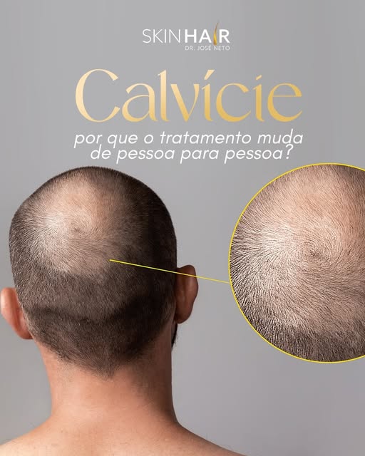 Calvície: por que o tratamento muda de pessoa para pessoa? 🧔🏻

A queda de cabelo pode ter diferent