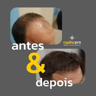 #AnteseDepois O melhor testemunho visual de um transplante capilar com resultado natural. Restaure a