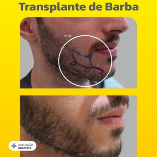 Quer ter uma barba mais cheia, definida e natural?
O transplante de barba é a solução ideal para que