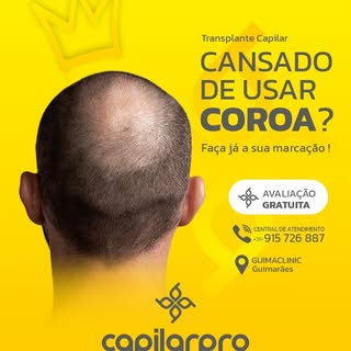 Cansado de usar “coroa”?
Restaure a sua imagem com um transplante capilar de aparência natural e res