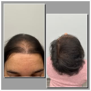 Antes & Depois – Transplante Capilar Feminino

Resultado apenas aos 6 meses (o resultado final apena