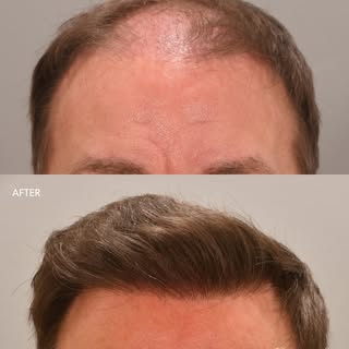 August marks International Hair Loss Awareness Month – a time to recognize that hair loss affects mi