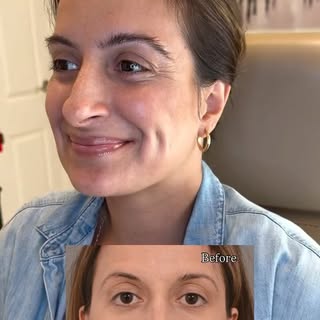 From early 2000s over-plucking to naturally full brows ✨

→ 400 grafts transplanted
→ 6 months of gr