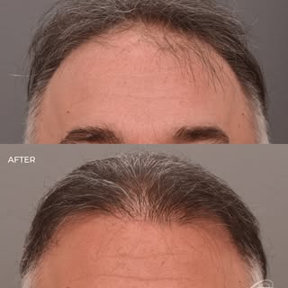 When a hair transplant is done correctly, it shouldn’t look like you had a hair transplant.

That st