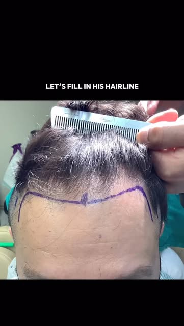 Getting the details right, in two stages.

His first transplant - 1,100 grafts - was about lowering 