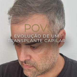 Confira a evolução do resultado do transplante capilar deste paciente que se incomodava com a falta 